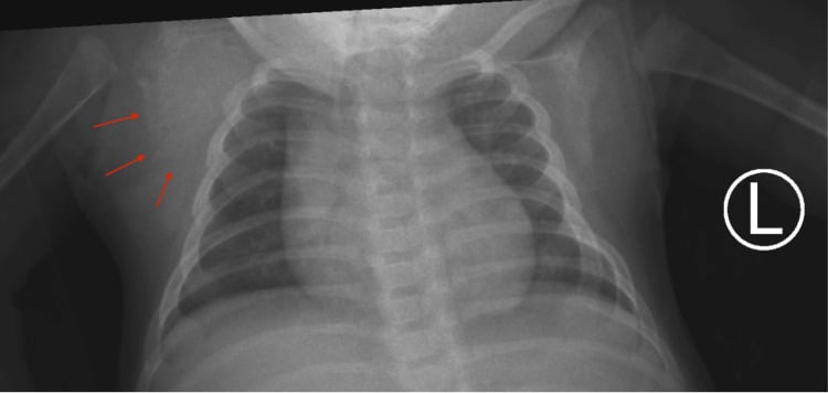 Frontal infant chest radiograph with red arrows marking sclerosis and expansion of the right scapula