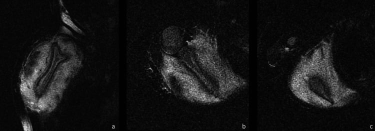 Three MRI panels (a to c) of an infant scapula showing high signal around the bone from periostitis and oedema of the surrounding muscle