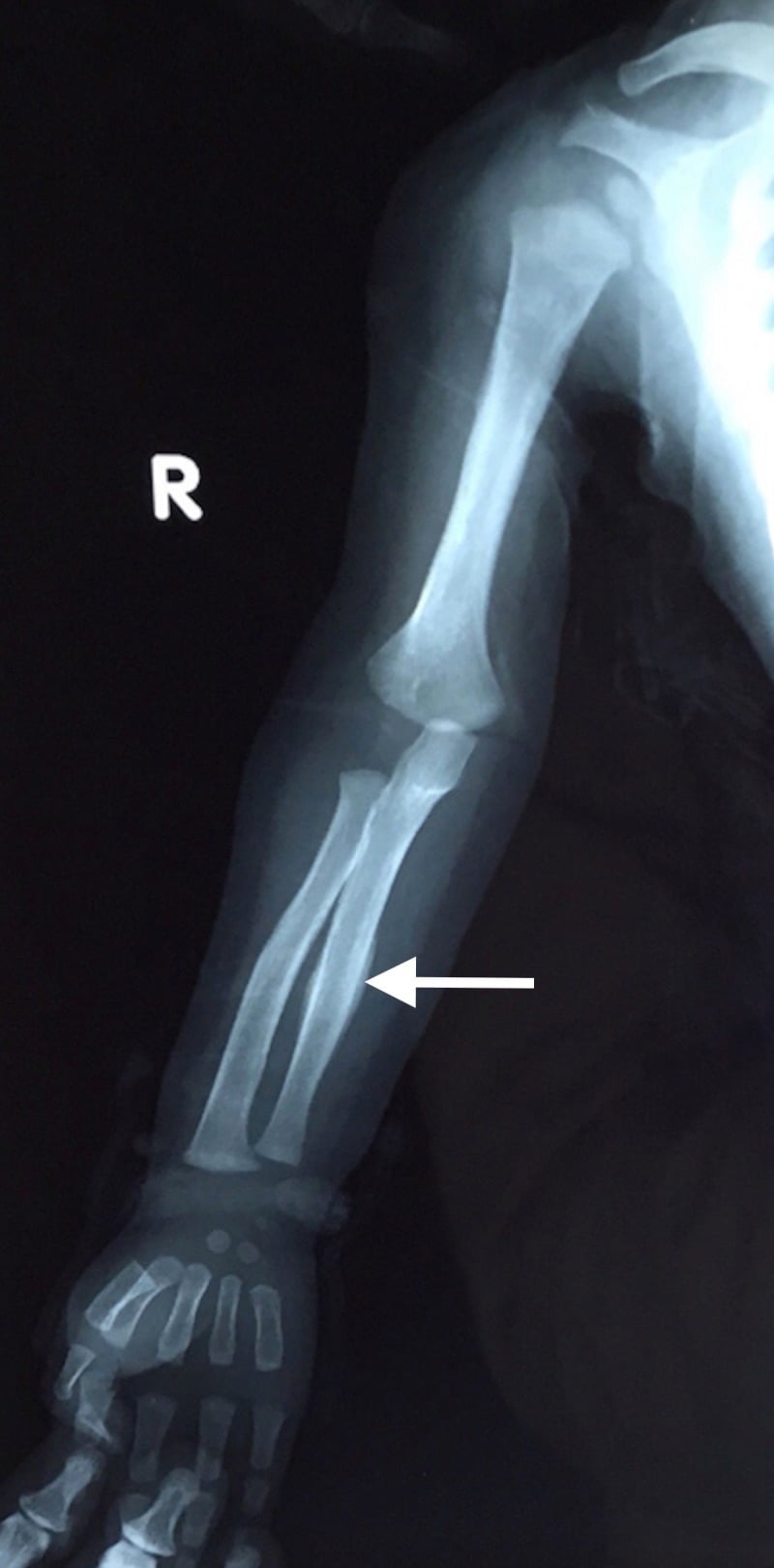 Infant right forearm radiograph showing smooth periosteal new bone along the ulnar diaphysis (arrow)