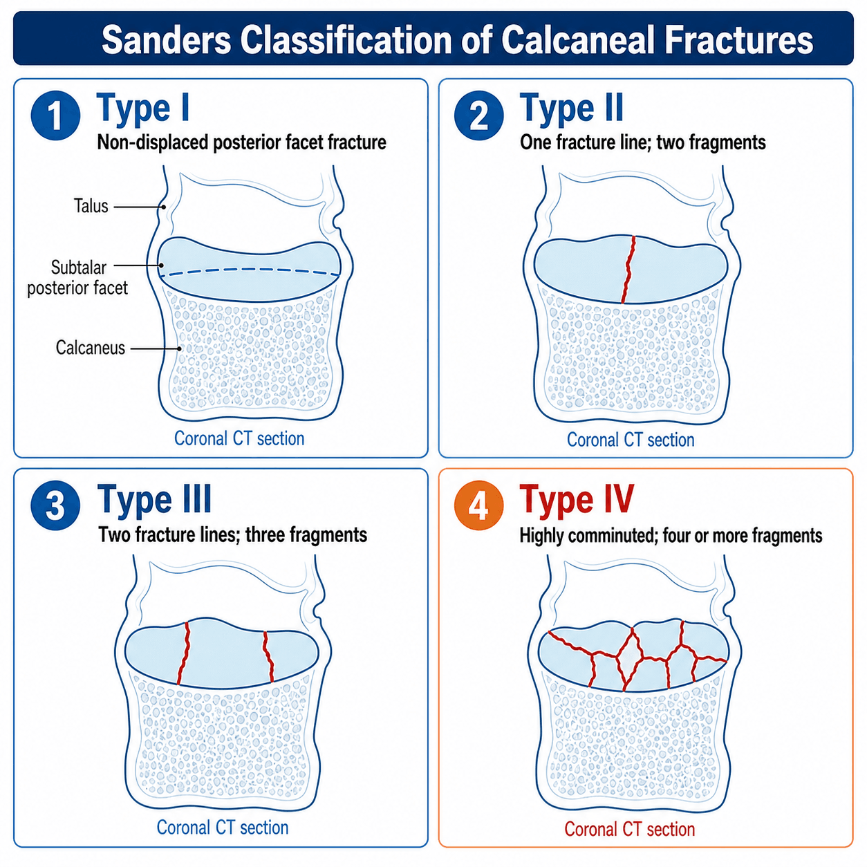 Sanders classification of calcaneal fractures
