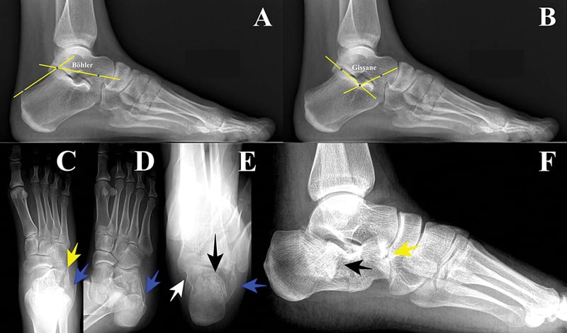 Bohler angle measurement on lateral radiograph