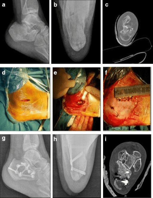 Calcaneal fracture ORIF via sinus tarsi approach - comprehensive case
