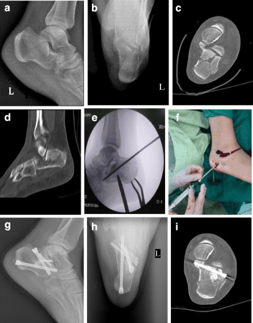 Percutaneous screw fixation of calcaneal fracture - 9-panel comprehensive case