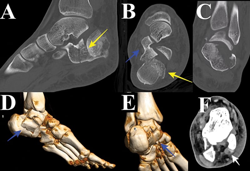CT evaluation of calcaneal fracture showing sagittal, axial, and 3D reconstruction views