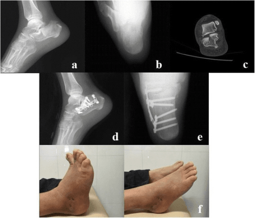 Complete calcaneal fracture case from injury to healed outcome