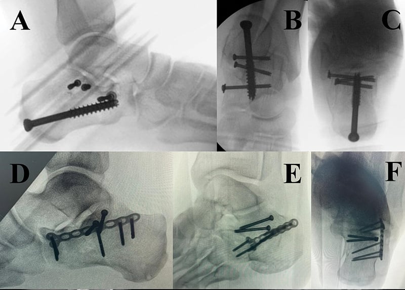 Calcaneal fracture plate and screw fixation techniques