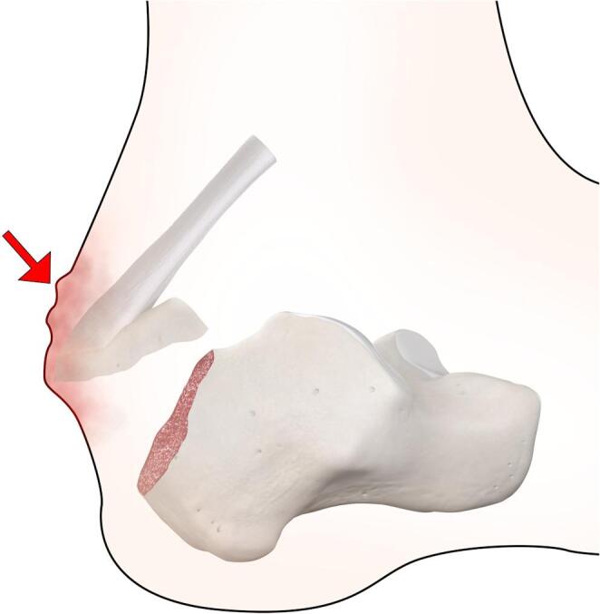 Schematic of posterior heel skin impingement by an avulsed tuberosity