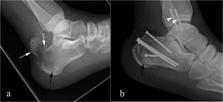 Type-one calcaneal tuberosity avulsion before and after screw fixation