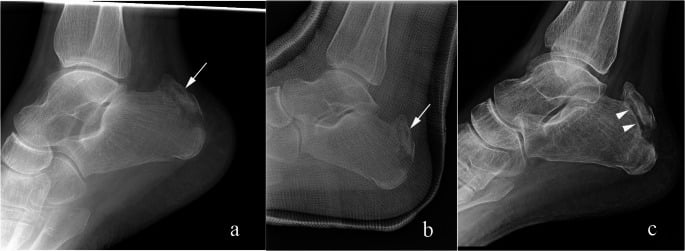 Progressive nonunion of a conservatively treated calcaneal tuberosity avulsion