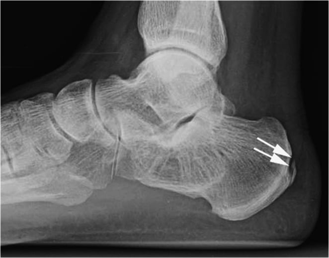 Small mildly displaced calcaneal tuberosity avulsion fracture