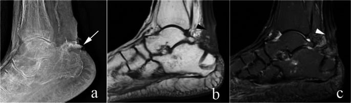 Skin breakdown after calcaneal tuberosity avulsion