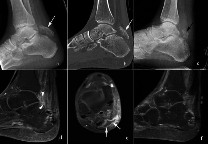 Infection and failed Achilles reconstruction after delayed avulsion treatment