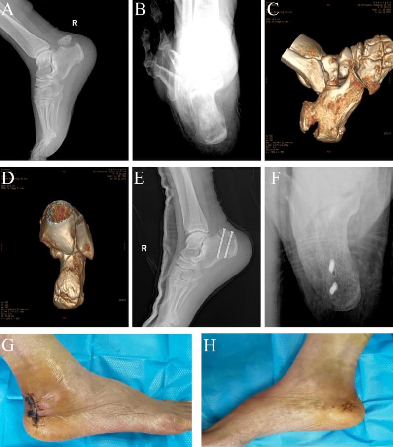 Union after screw and Nice-knot fixation of a type-two avulsion