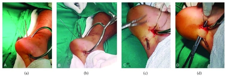Intraoperative photos showing cerclage wire tension band technique for calcaneal tuberosity fracture