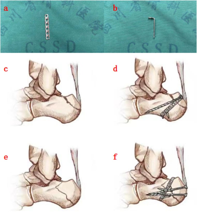 Preformed L-shaped hook plate and its placement for smaller and larger beak fragments