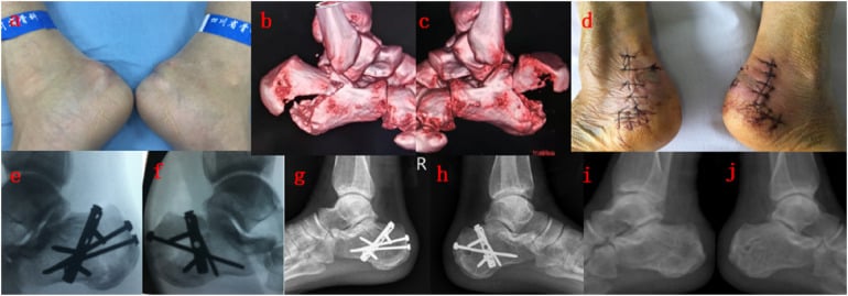 Bilateral beak fractures treated with precontoured hook plates