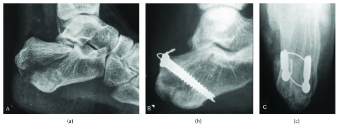Pre-operative and post-operative radiographs of calcaneal tuberosity avulsion fracture with tension band wire fixation