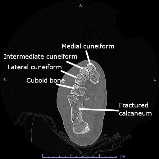Axial CT scan of the foot showing calcaneocuboid joint anatomy with labeled midfoot bones and a calcaneal fracture