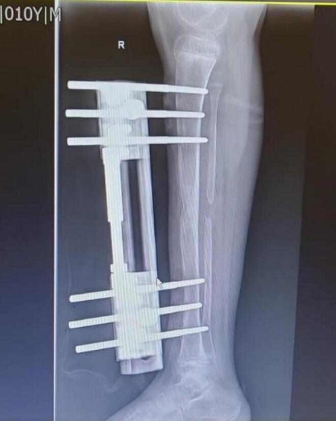 Radiograph during tibial distraction with a monolateral rail fixator