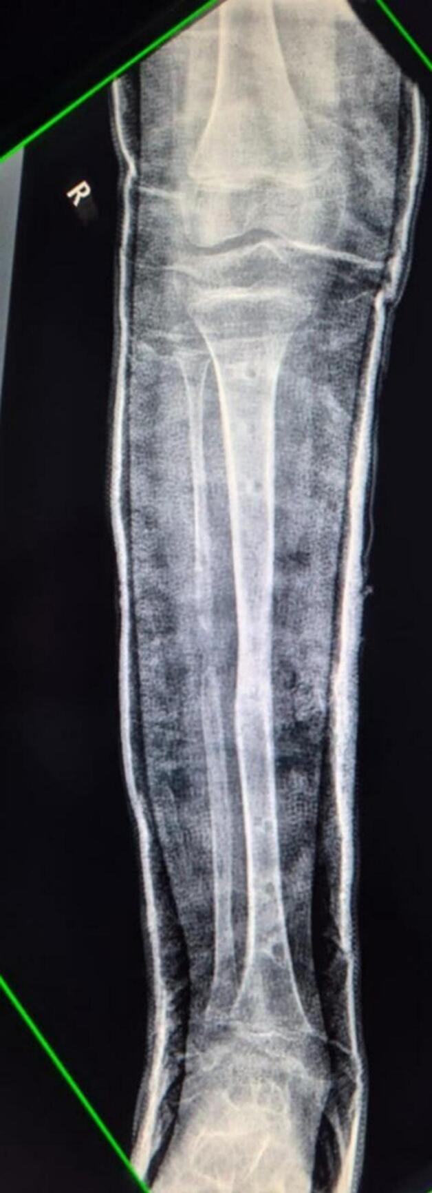 Consolidated tibial regenerate protected in a cast after fixator removal