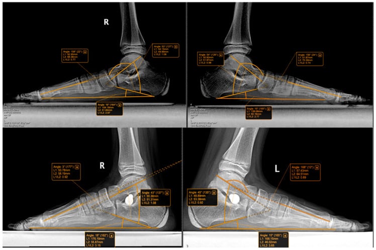 Weight-bearing radiographs before and after subtalar arthroereisis for flexible paediatric flatfoot