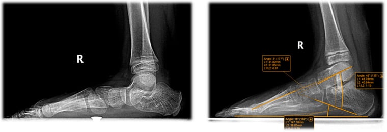 Weight-bearing radiographs before and after Grice arthrodesis for rigid paediatric flatfoot