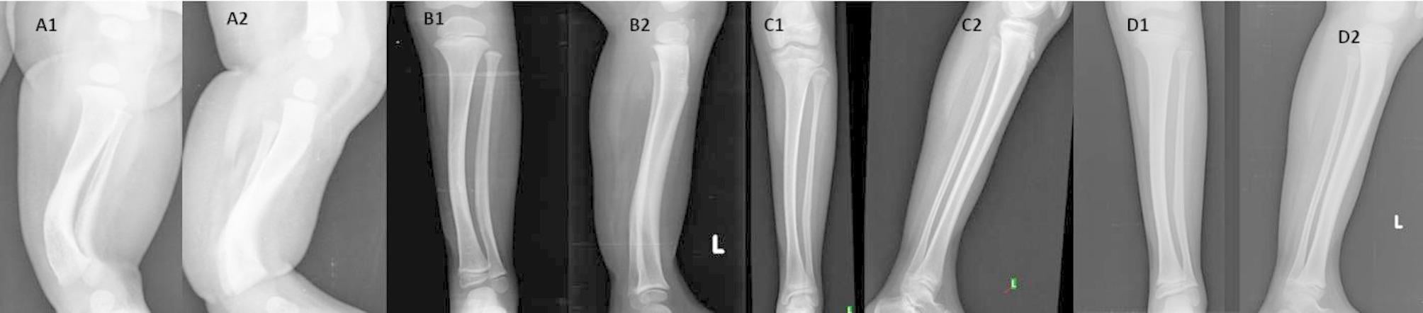 Serial AP and lateral radiographs showing spontaneous remodelling of posteromedial tibial bowing