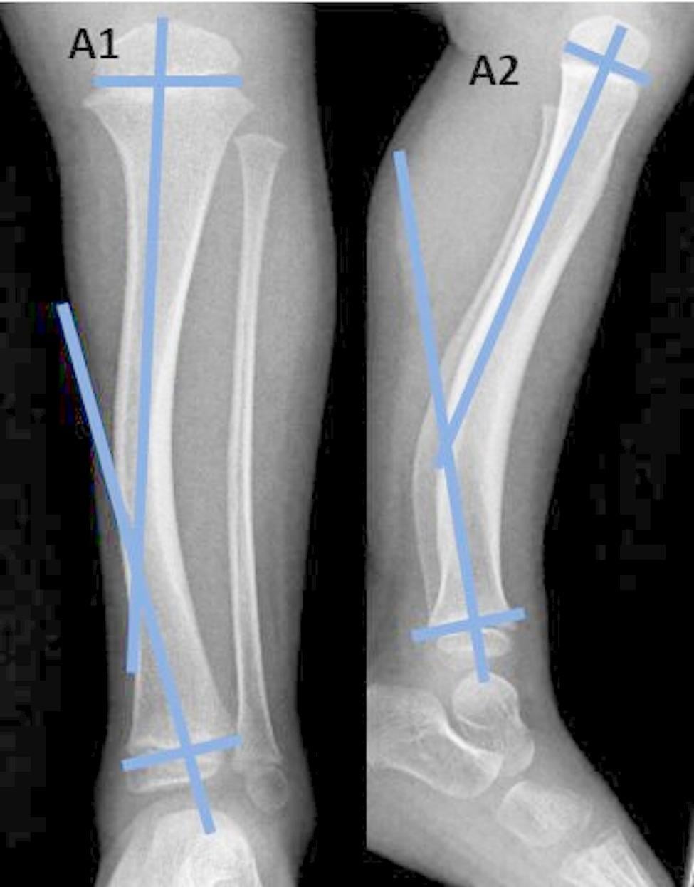 Interphyseal-angle measurement in posteromedial tibial bowing