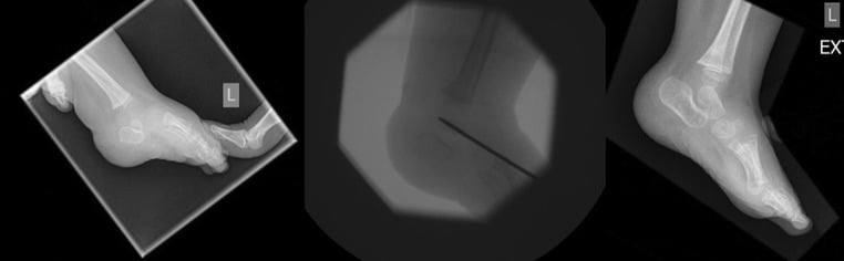 Preoperative intraoperative and postoperative radiographs of congenital vertical talus