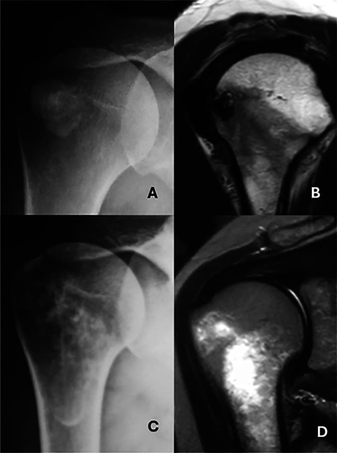 AP radiograph and oblique sagittal T2 MRI of rotator cuff calcific tendinopathy