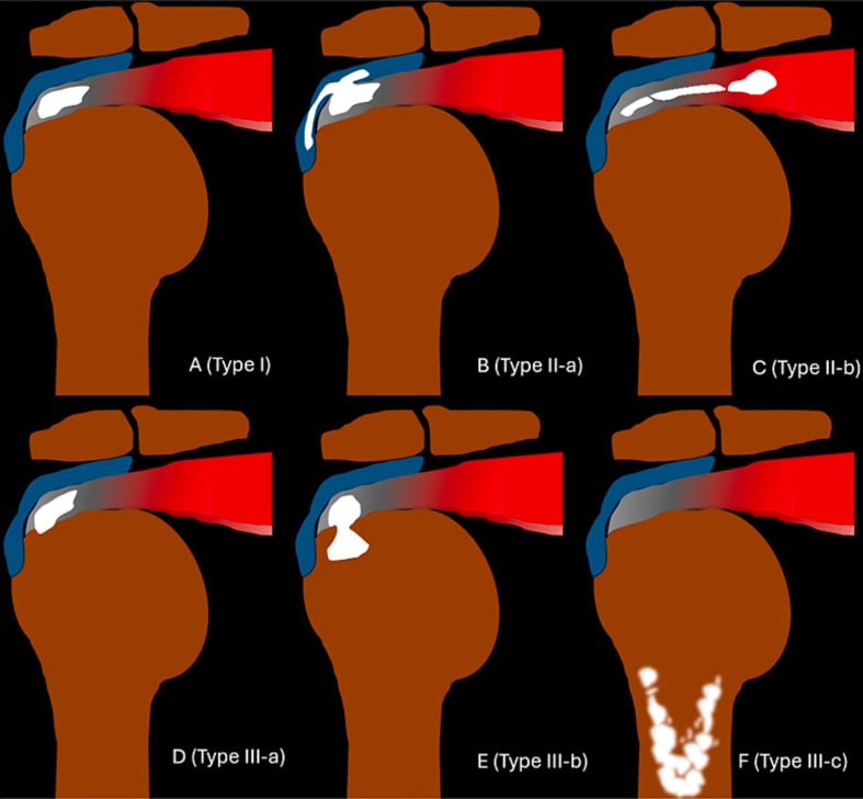 Schematic illustration of Gärtner and Simons calcific tendinopathy classification
