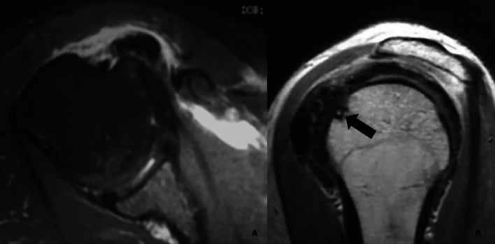 Axial T1 and T2 MRI of Gärtner Type III calcific deposit with intraosseous extension