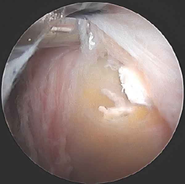 Arthroscopic view demonstrating toothpaste-like milk of calcium extrusion from tendon