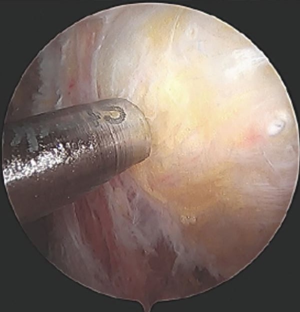 Arthroscopic view showing spinal needle localization and barbotage of calcific deposit