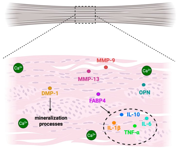 Pathophysiologic schematic diagram of MMPs and inflammatory cytokines in calcific tendinopathy