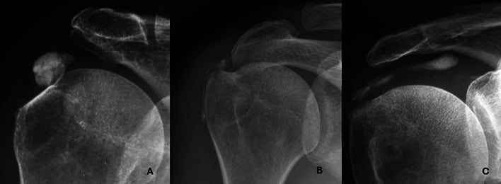 Shoulder radiographs showing the classic amorphous calcific deposit of hydroxyapatite deposition disease in the rotator cuff