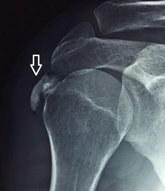 AP X-ray of the shoulder showing calcific tendinitis with arrow pointing to dense calcific deposit in the supraspinatus tendon