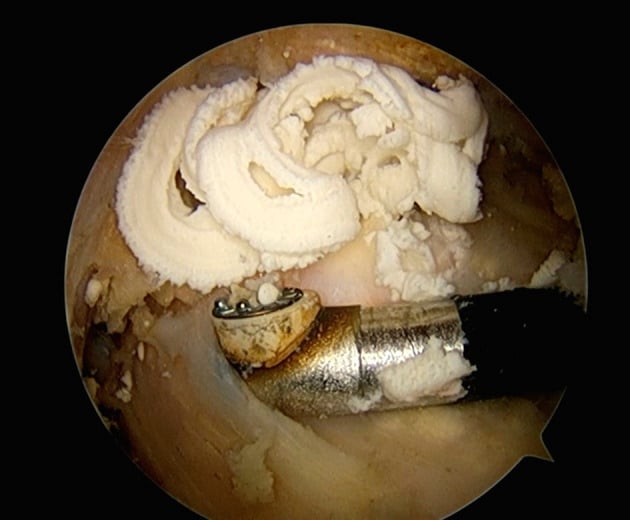 Arthroscopic view of toothpaste-like calcium being expressed from a supraspinatus tendon deposit by blunt compression