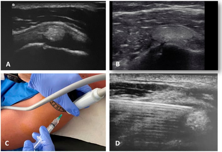 Four-panel ultrasound-guided barbotage sequence showing the calcific deposit, probe and needle positioning, and intradeposit needle placement