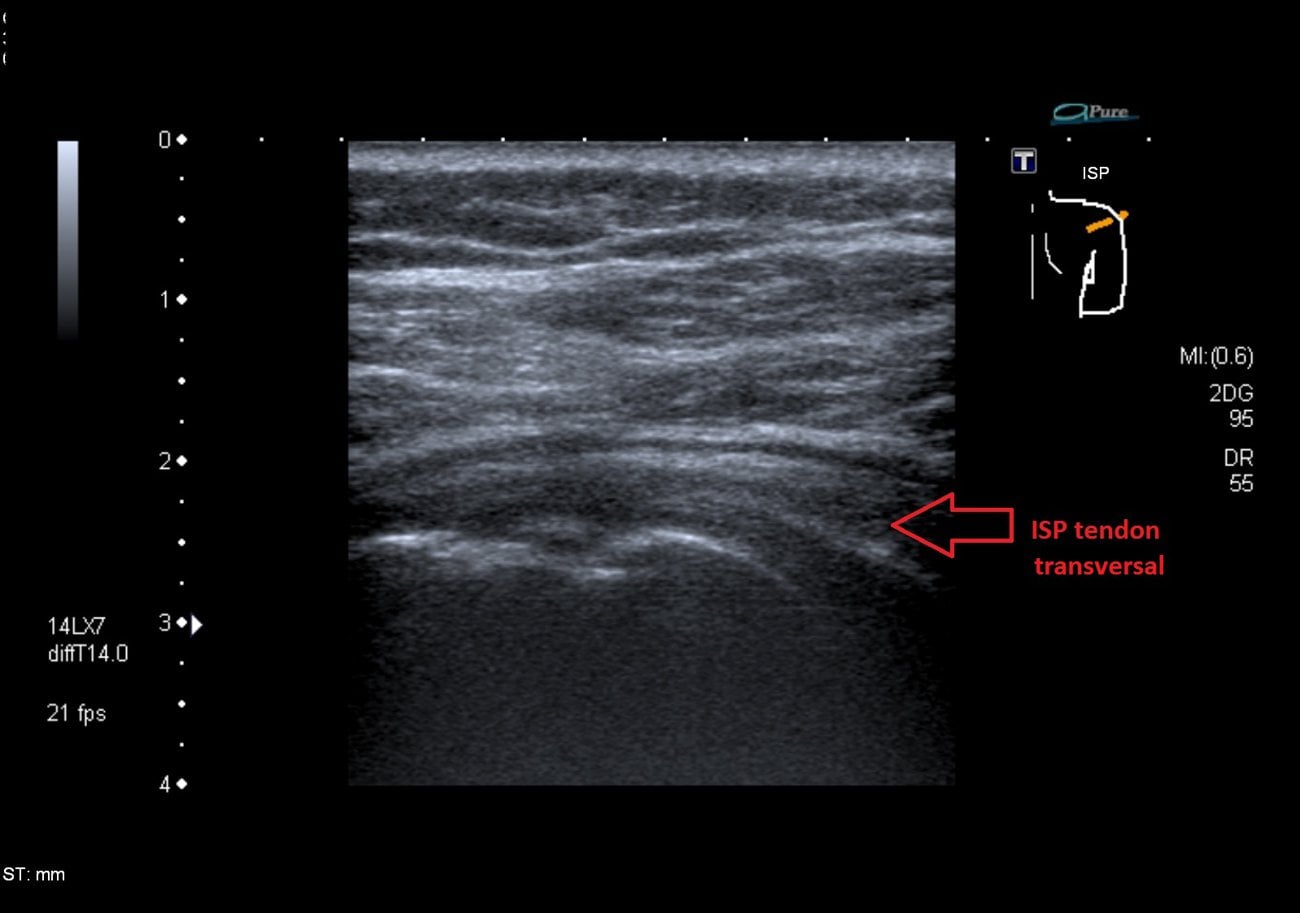 Ultrasound of the infraspinatus tendon (transverse view) showing a hyperechoic calcific deposit at the tendon insertion.