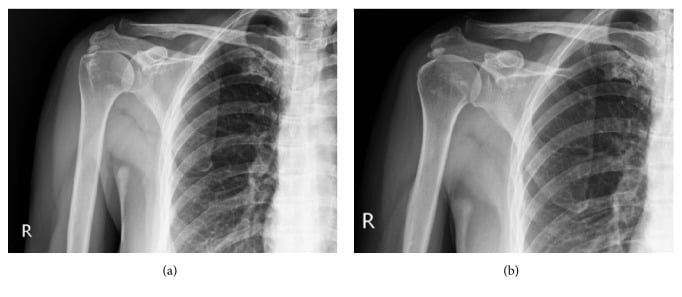 Paired AP shoulder radiographs before and six months after extracorporeal shock-wave therapy showing persistence of a dense Gärtner type I deposit