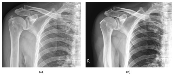 Paired AP shoulder radiographs before and six months after extracorporeal shock-wave therapy showing complete resorption of a Gärtner type II deposit
