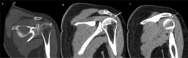 Serial coronal shoulder CT images showing calcium crossing the cortex into the greater tuberosity and leaving a rounded intraosseous defect