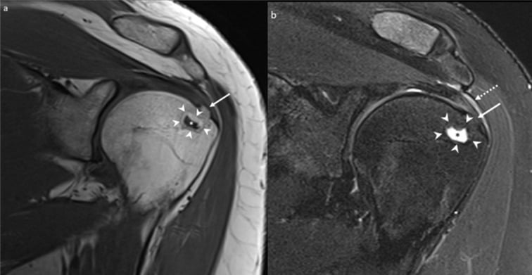 Coronal T1 and fat-suppressed T2 shoulder MRI showing an intraosseous greater-tuberosity cavity with a peripheral fat rim and surrounding oedema