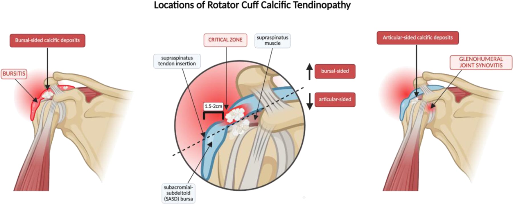 Three-panel shoulder anatomy illustration locating bursal-sided and articular-sided rotator cuff calcific deposits around the supraspinatus critical zone
