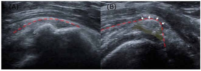 Paired shoulder ultrasound images comparing an arc-shaped calcific deposit with shadowing against a softer deposit contacting the bursal wall with pericalcific fluid