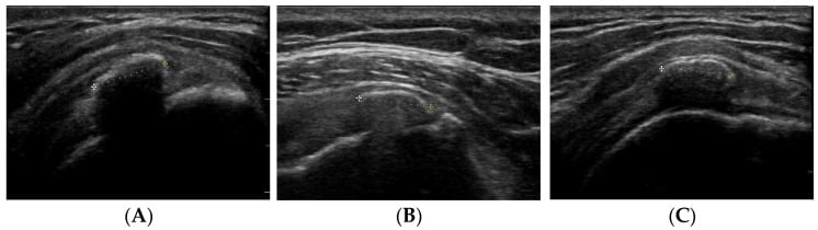 Three ultrasound appearances of rotator cuff calcification showing strong, partial and absent posterior acoustic shadowing