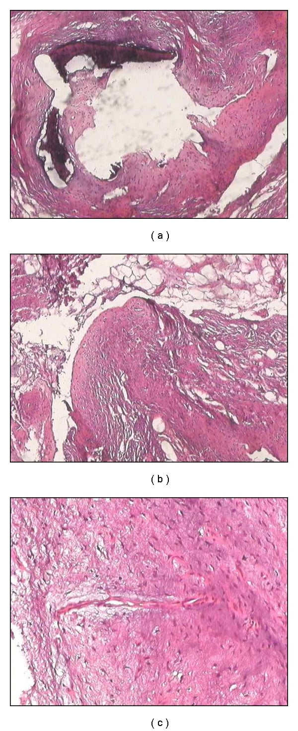Three histology panels showing calcific deposits in dense fibrous tissue, a fibrous nodule beside fat, and bland spindle cells