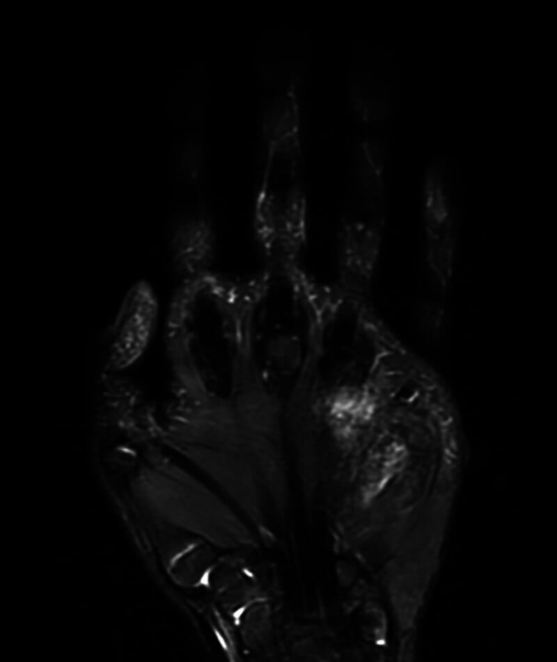 Coronal T2 MRI demonstrating deep palmar calcifying aponeurotic fibroma mass