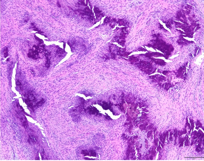 Low-power H&E photomicrograph of calcifying aponeurotic fibroma